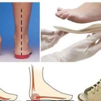 Ортопедическая обувь